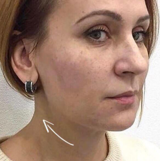 Дівчина до процедури